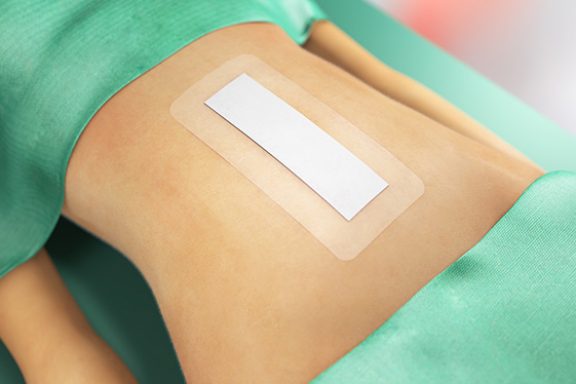 Sorbact-bandasje på kirurgisk snitt på magen.