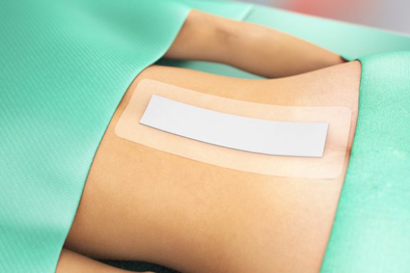 Sorbact-bandasje på ryggen etter kirurgisk inngrep.