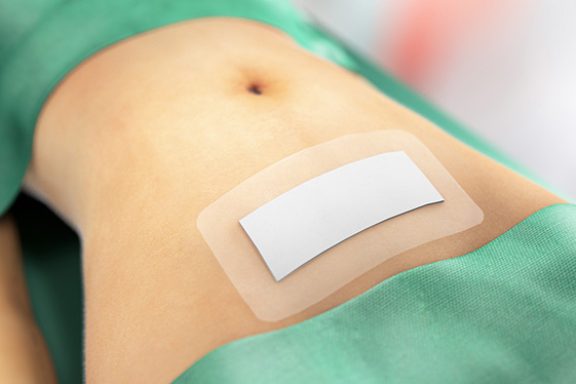 Sorbact-bandasje på magen etter keisersnitt.